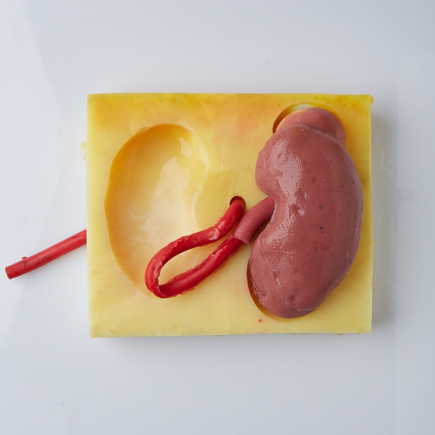 Partial Nephrectomy (Class II)