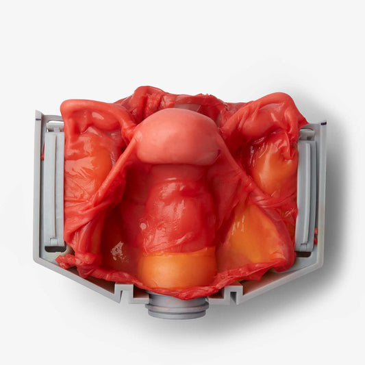Hysterectomy (Class IV)