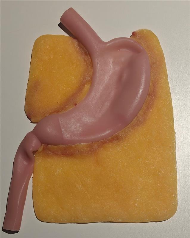 Gastric (Class III)