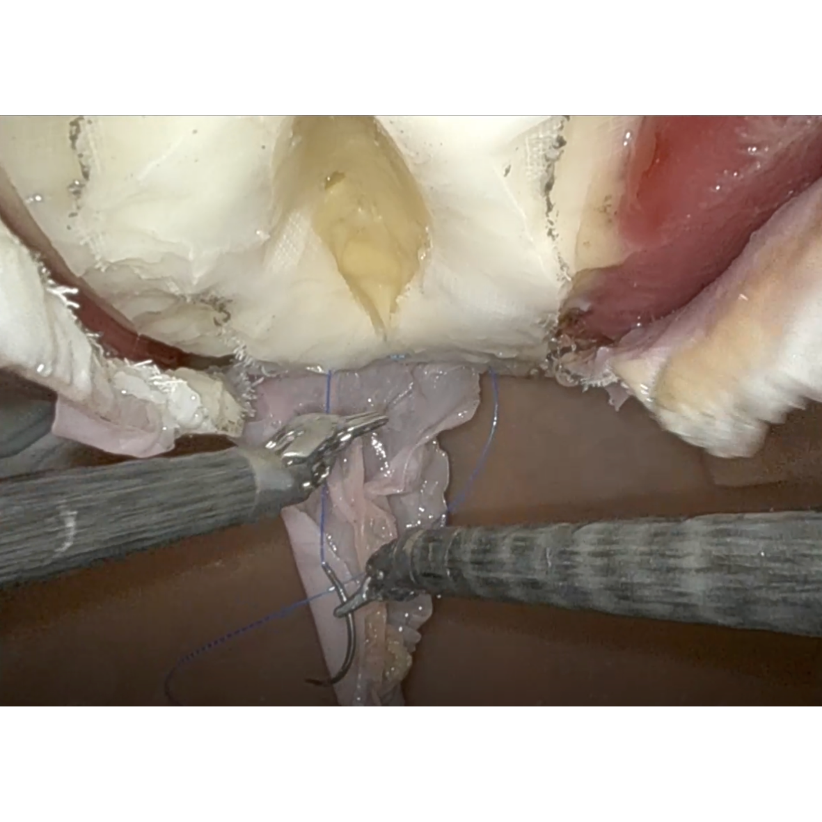 Ventral Hernia (Class II) - Hydrogel Surgical Training Model