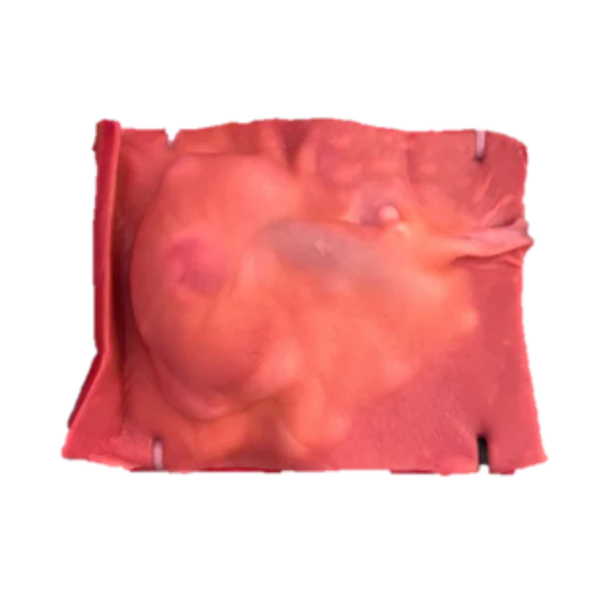 Partial Nephrectomy (Class IV)