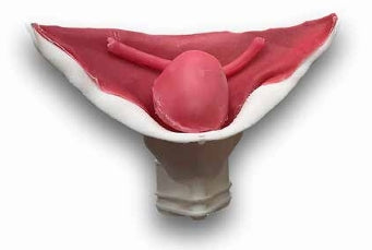 Vesicourethral Anastomosis (UVA Class III)