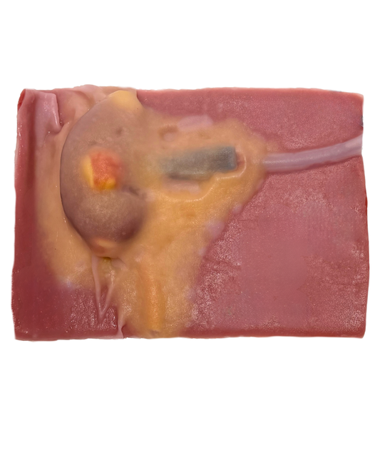 Partial Nephrectomy (Class IV)
