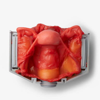 Hysterectomy (Class IV)