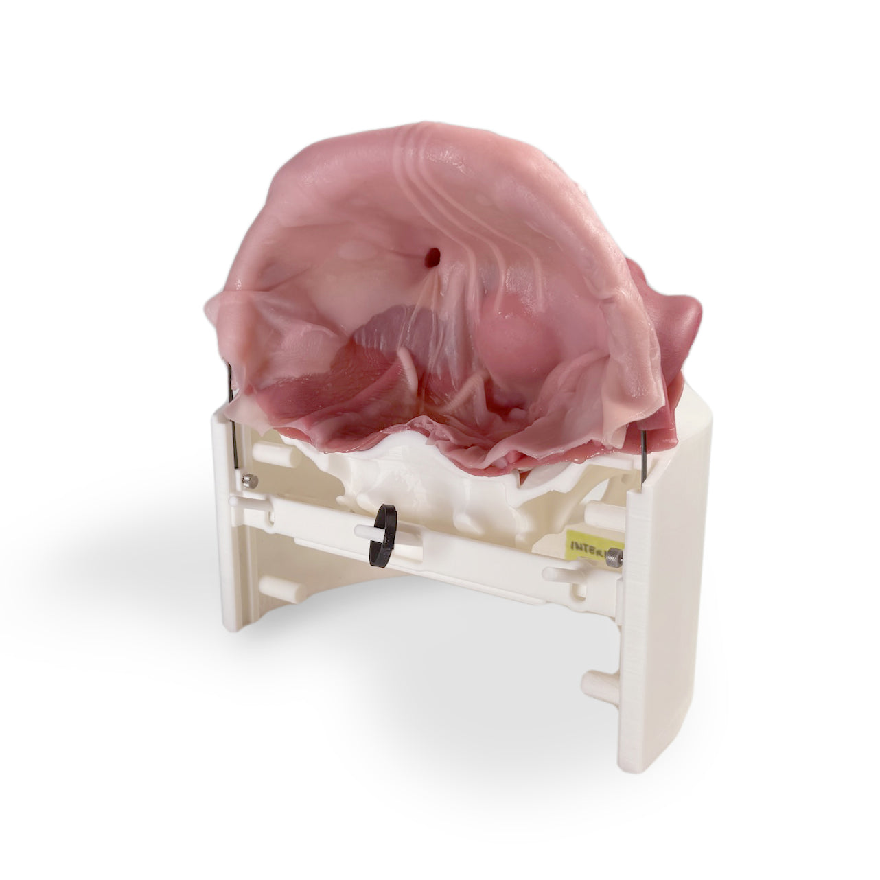 Inguinal Hernia (Class IV)