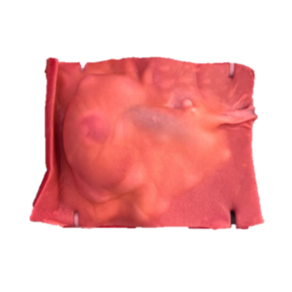 Partial Nephrectomy (Class IV)