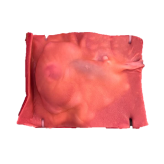 Partial Nephrectomy (Class IV)