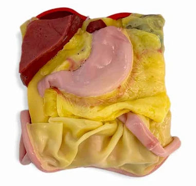 Gastric (Class IV)