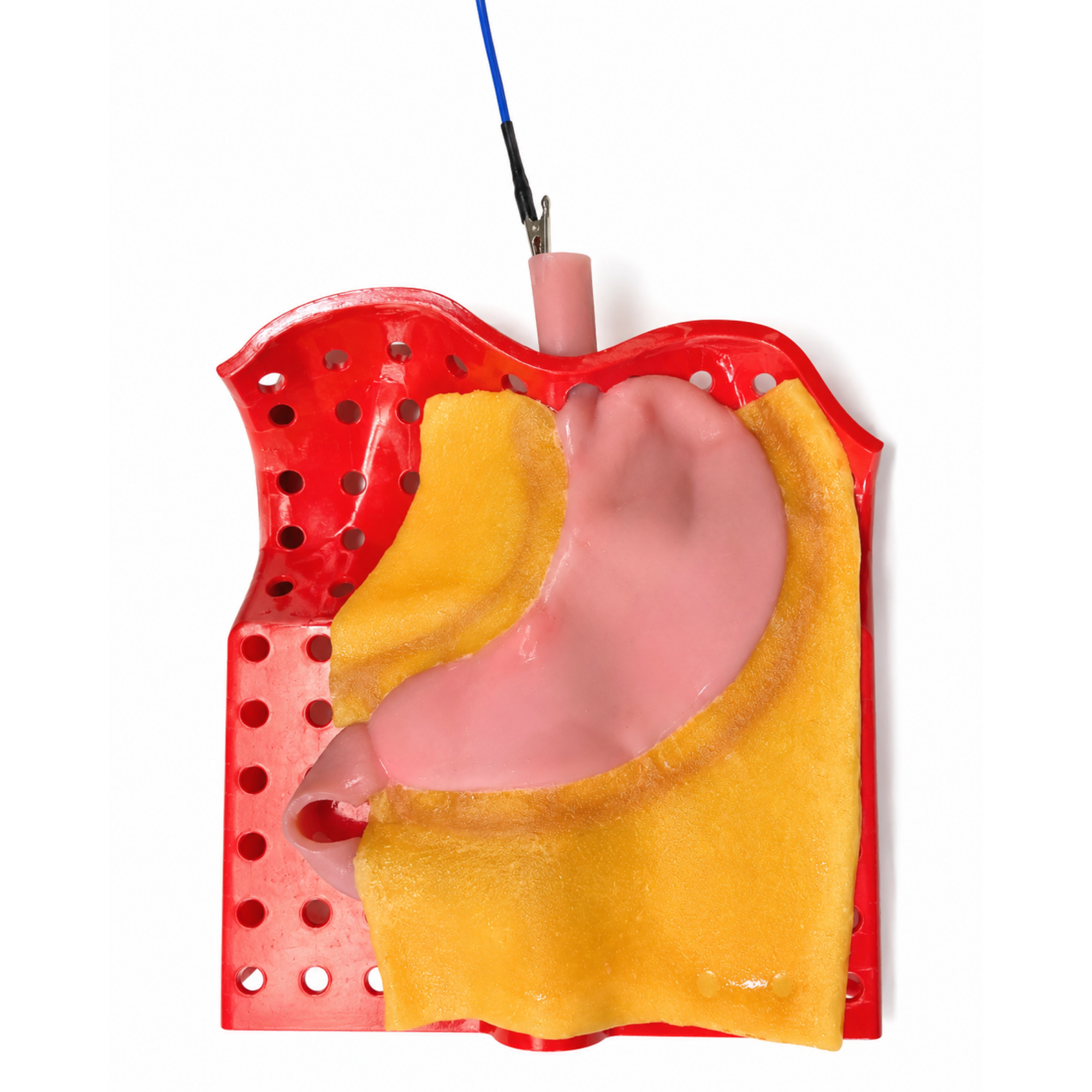 Gastric (Class III)