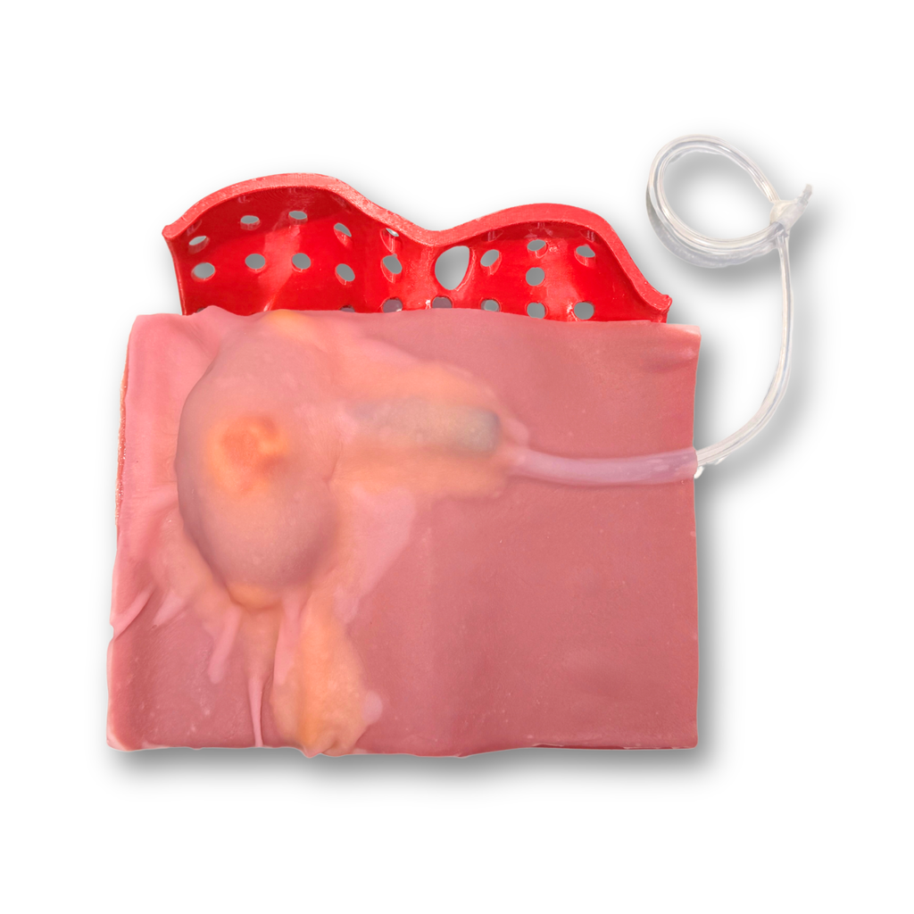 Partial Nephrectomy (Class IV)