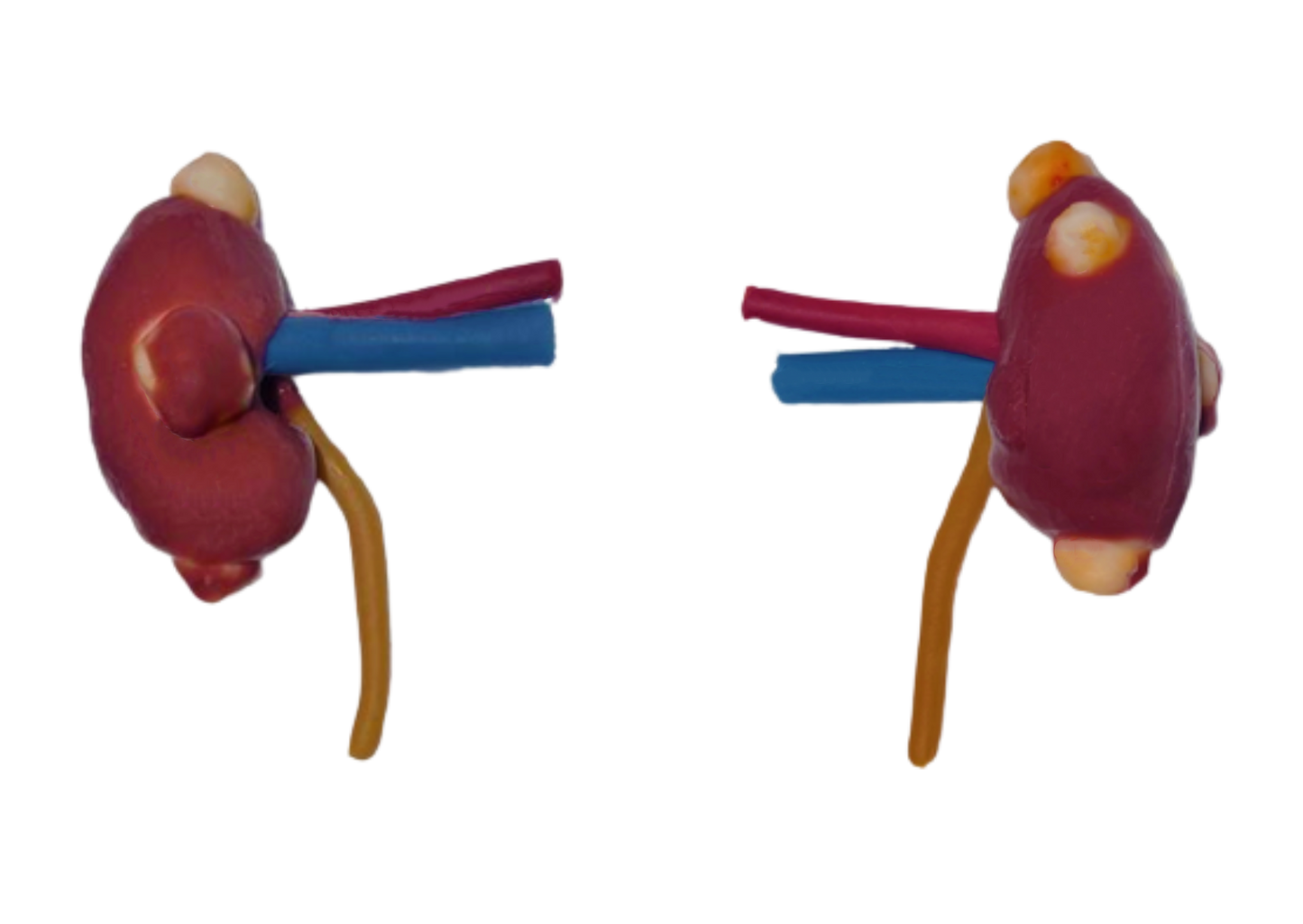 Partial Nephrectomy (Class IV)