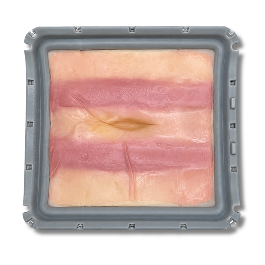 Ventral Hernia (Class II)